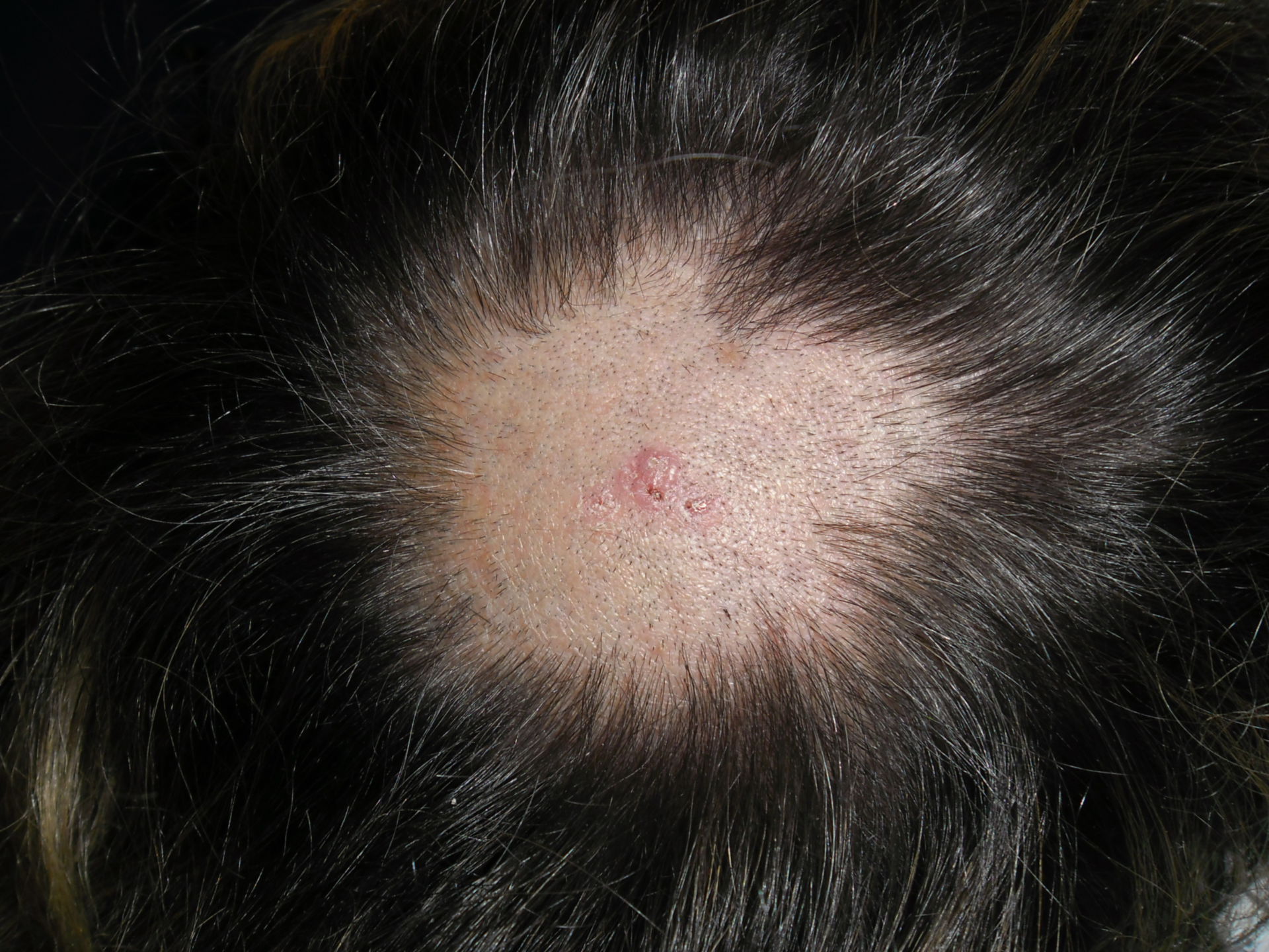 Basal cell carcinoma on the back of the head