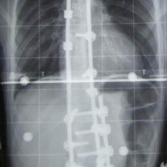 Spondylodese DocCheck Flexikon