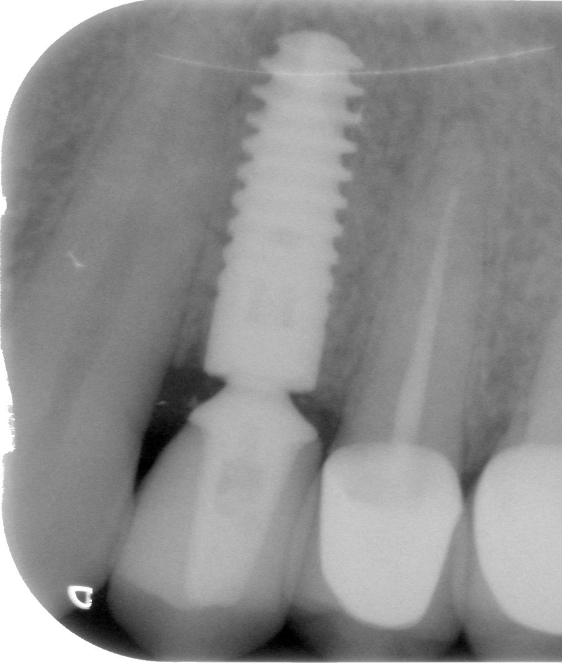 X-ray 2 after inplantation