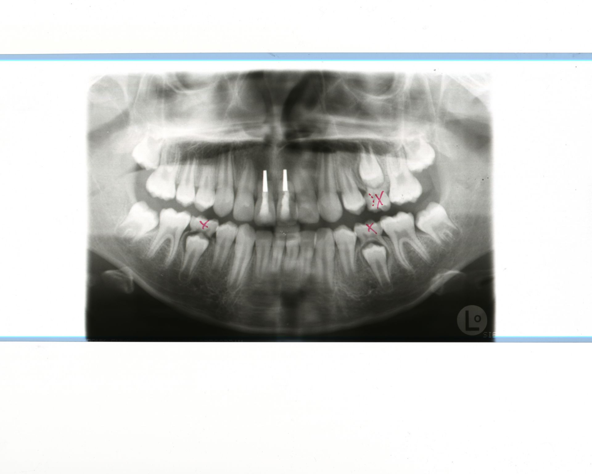 Control OPG. Around 16 months after a complex trauma to the frontal teeth