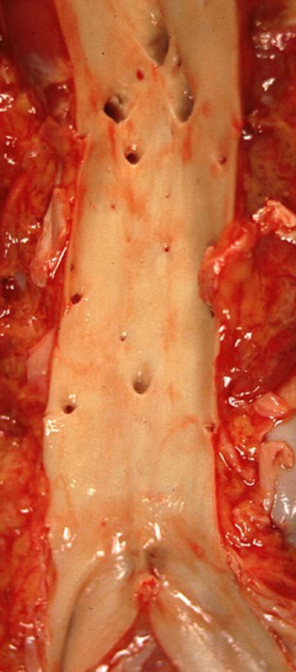 Aorta abdominalis (Normalbefund)