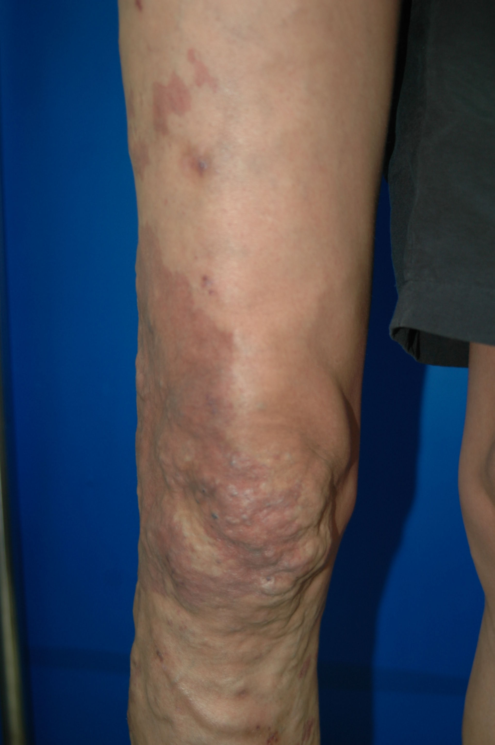 Klippel tranaunay syndrome  postop view by dr.ykshim