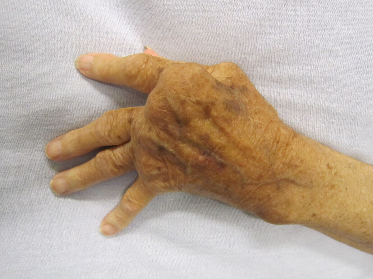 Rheumatoide Arthritis