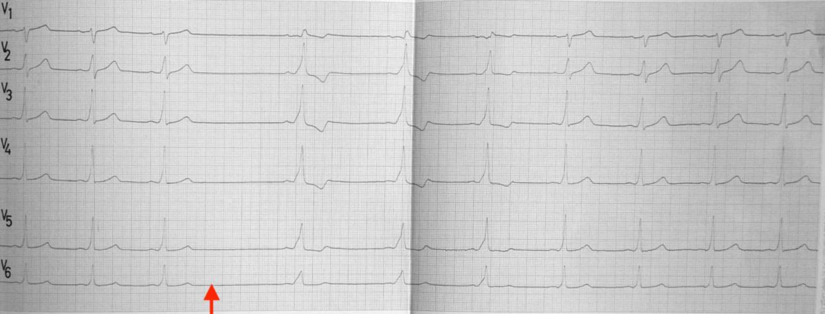 Elektrokardiogramm: Der rote Pfeil zeigt das Einsetzen von erhöhtem Vagotonus durch einen Carotis-Druckversuch.