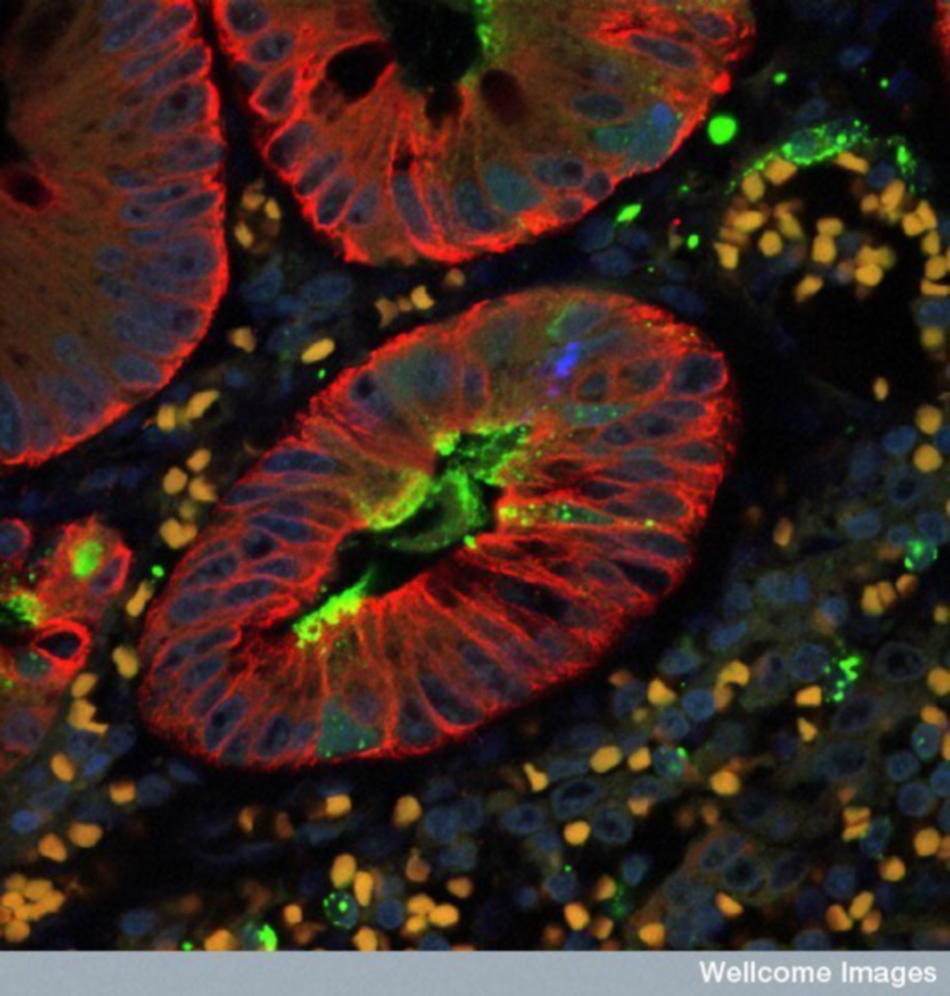 Fluoreszierende Mikrographie zeigt einen Abschnitt des menschlichen Anhangs infiziert mit dem Masernvirus