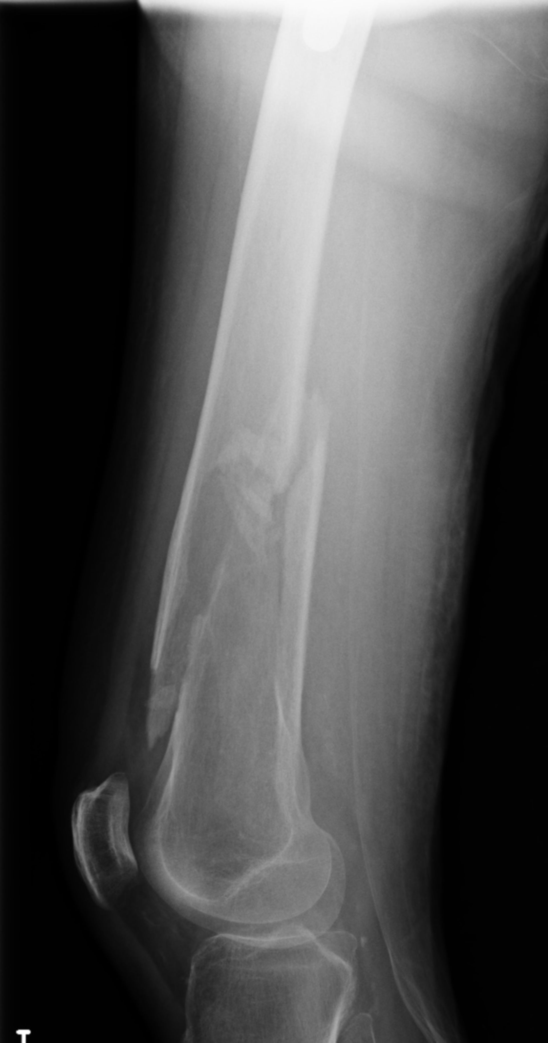 Distal femoral fracture