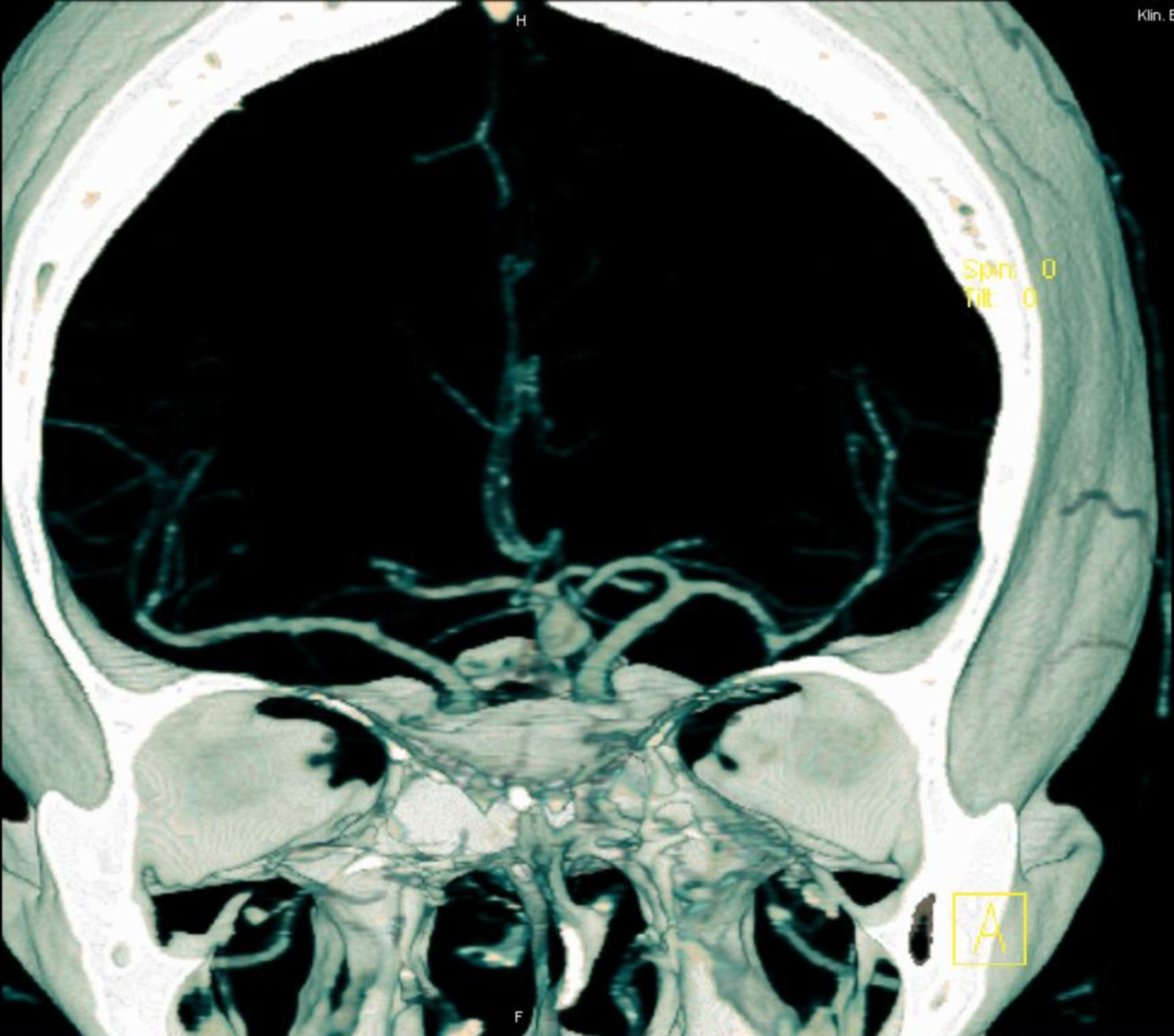 Aneurysm of the left anterior communicating branch (RCA)
