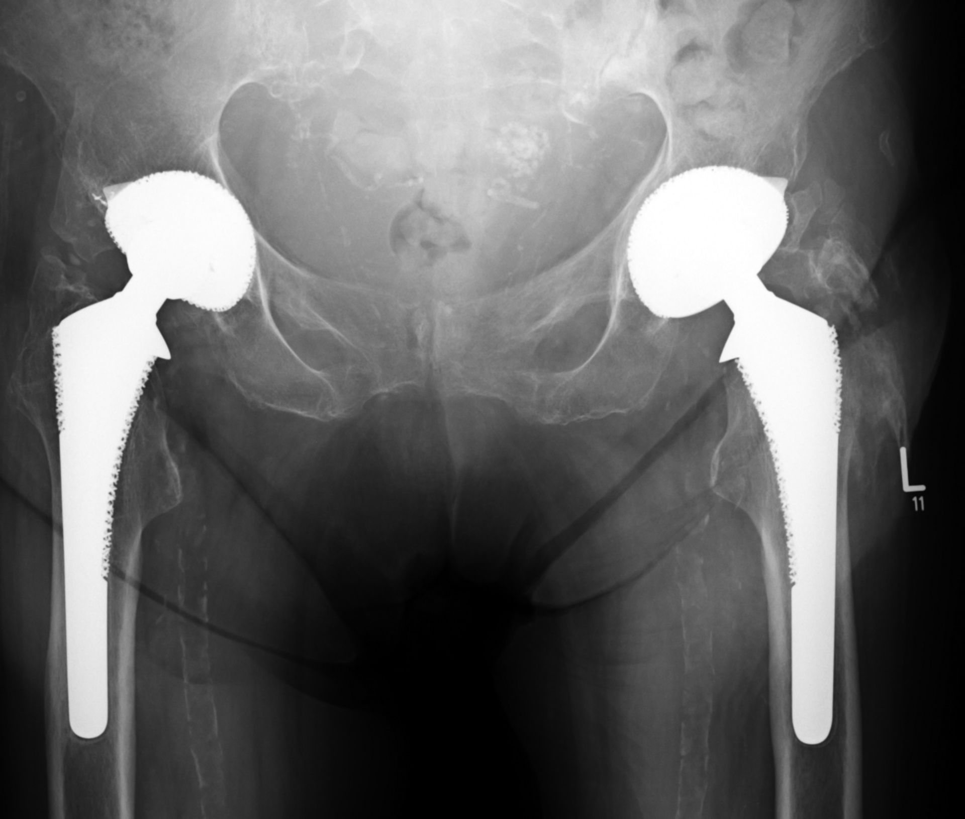 Osteoporosis of the hip - bilateral total hip replacement
