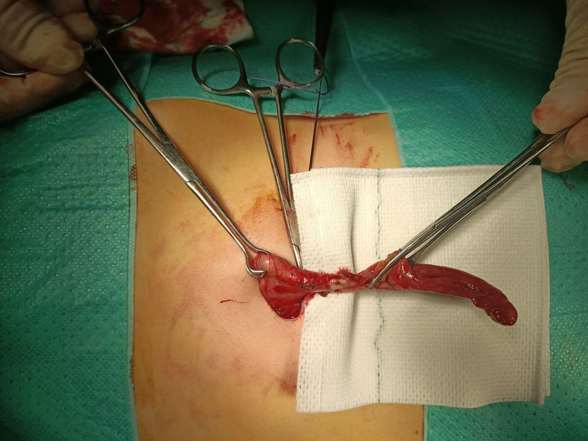 Entzündete Appendix vermiformis