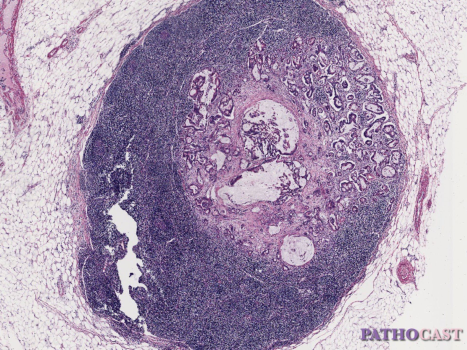 Lymph node metastasis of colon cancer