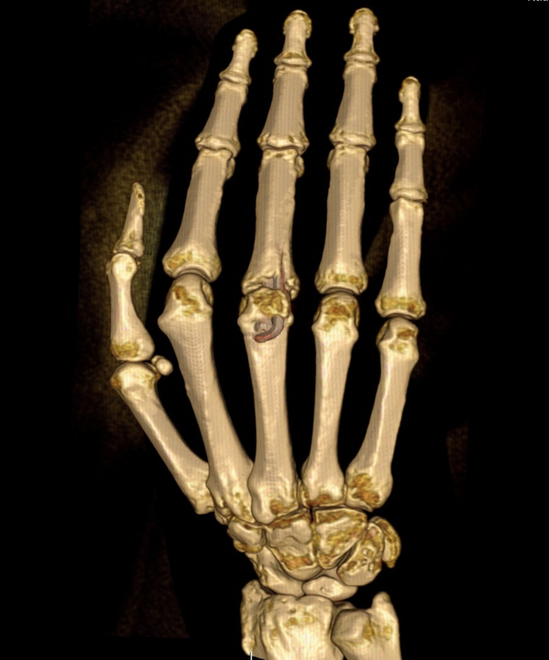 CT-scan: Reconstruction of the hand