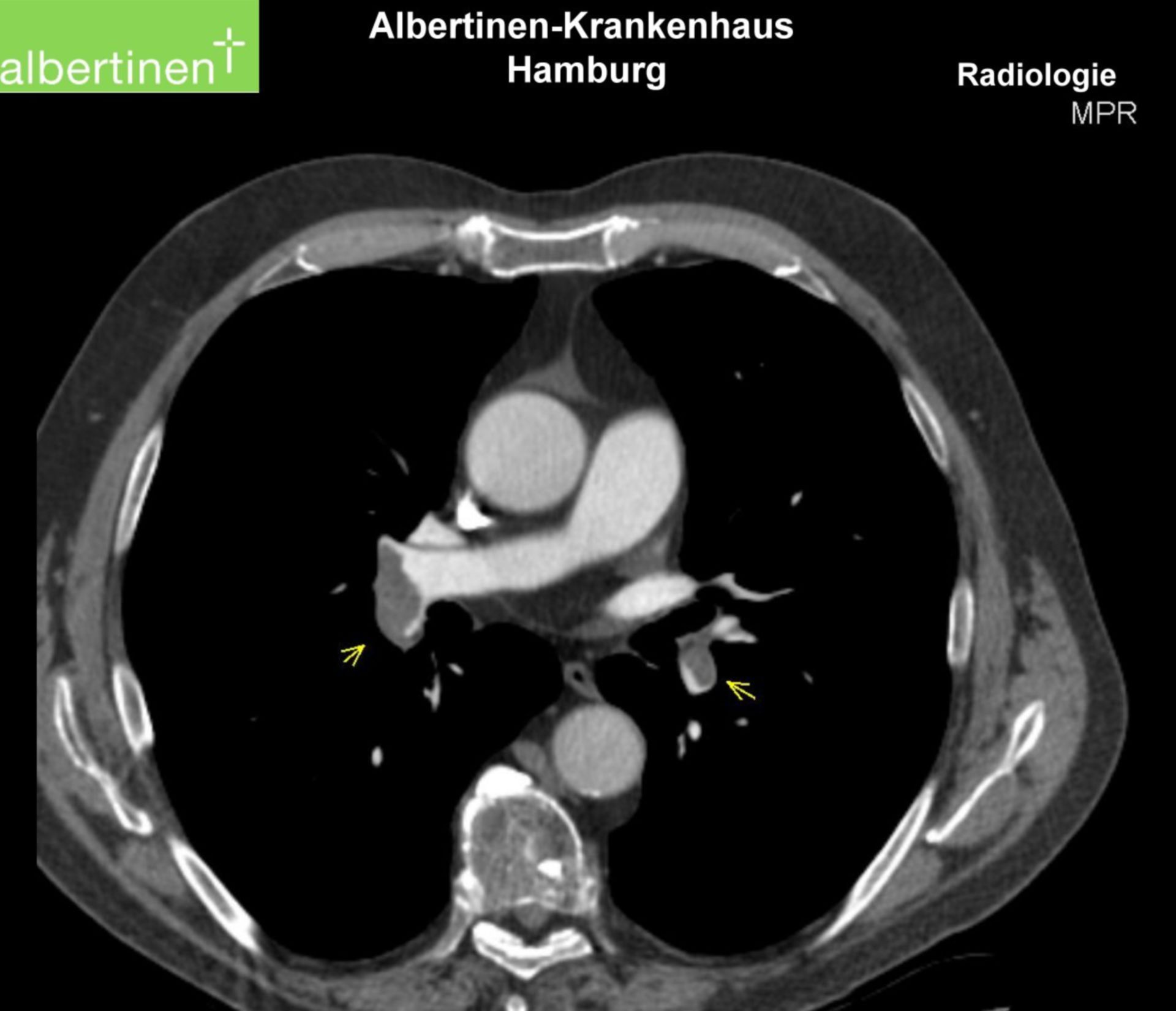 CT-Thorax Lungenembolie (3)