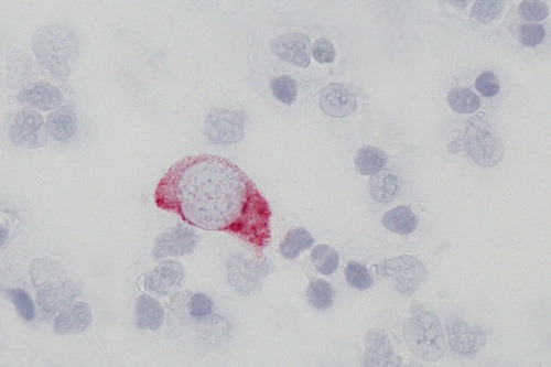 Eine HMB45 positive (rot markierte) Melanomzelle umgeben von nicht markierten ( blauen) Lymphknotenzellen. © Universitätsklinikum Tübingen