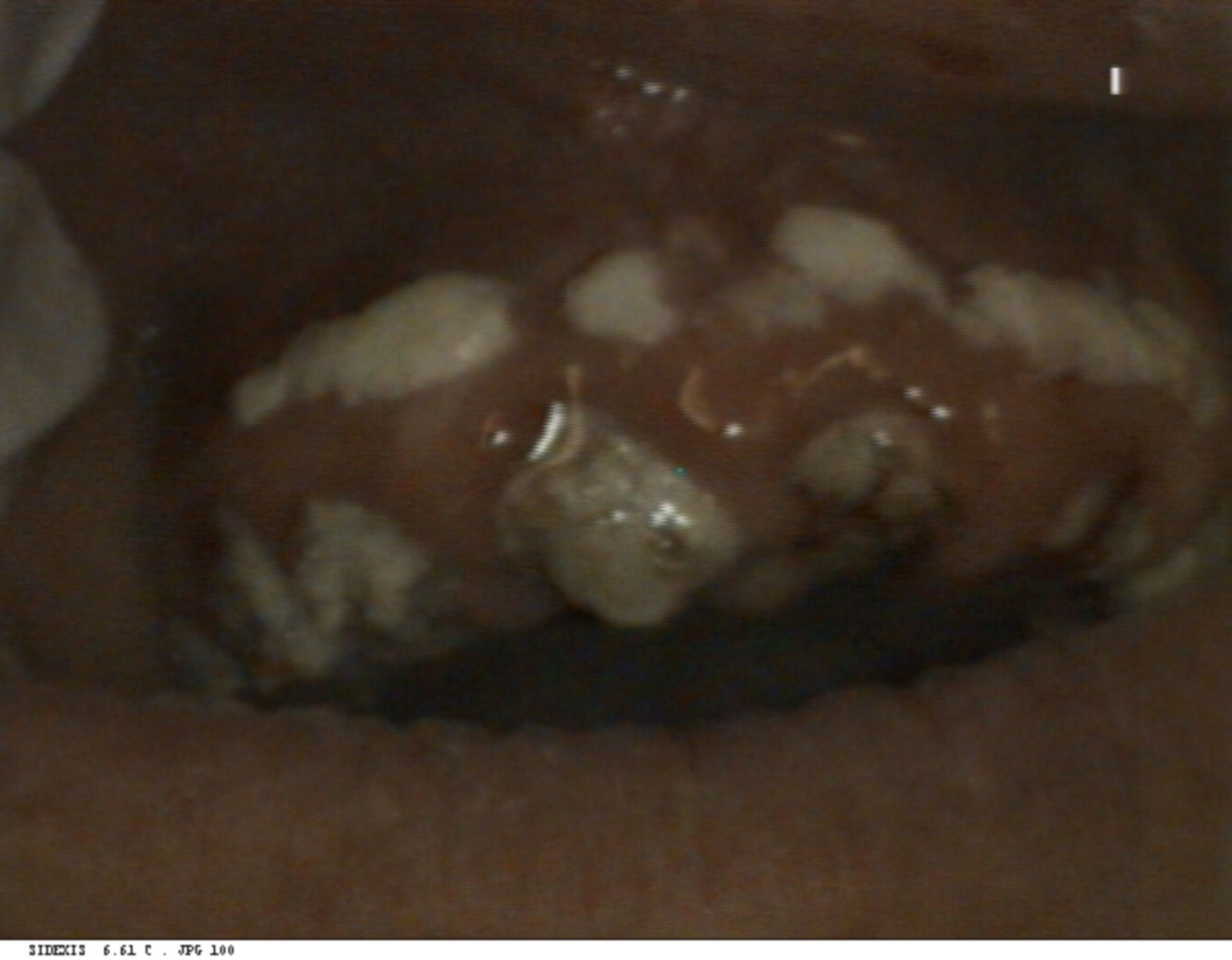 Mucocutaneous candidiasis