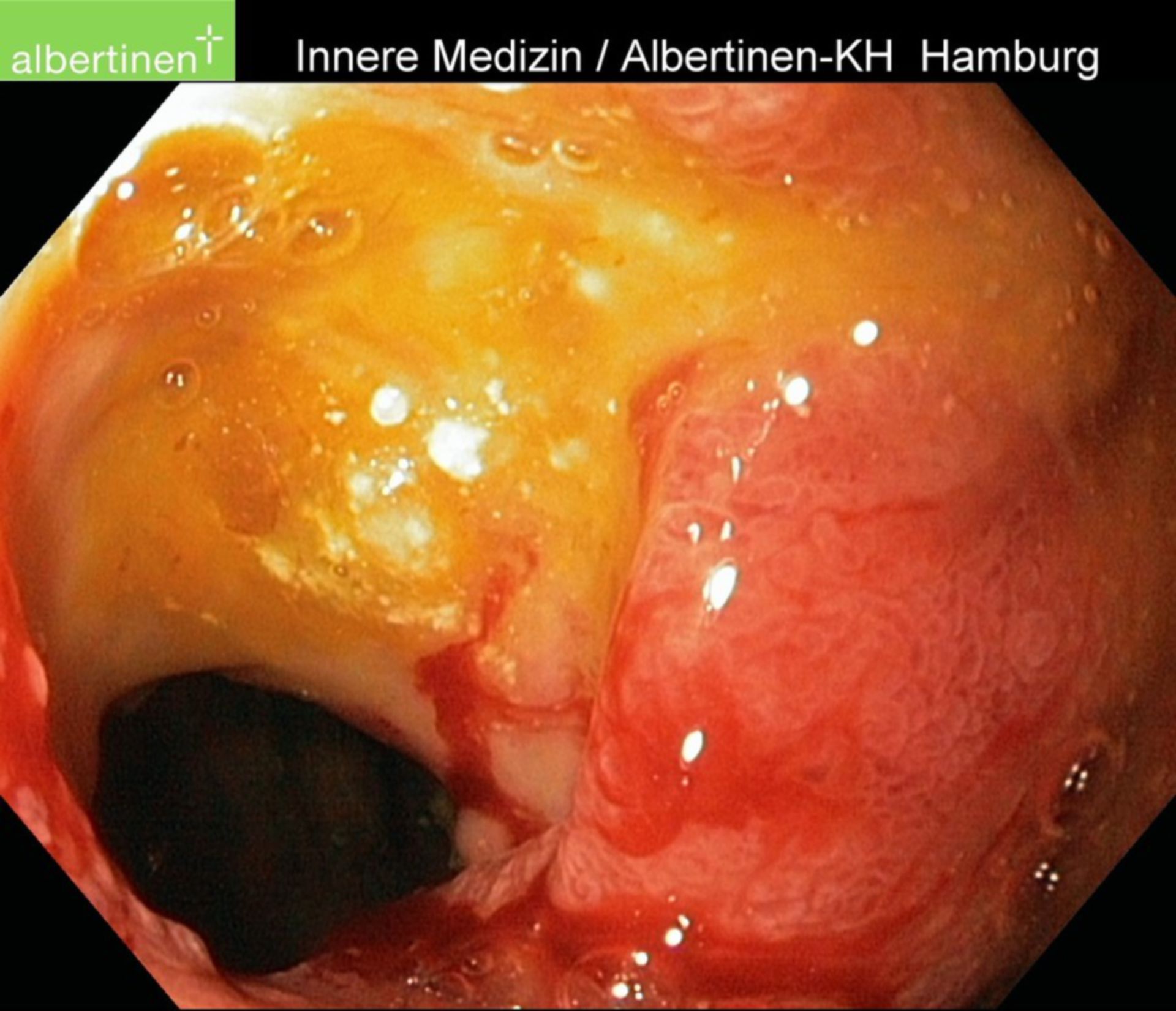 Duodenal ulcer