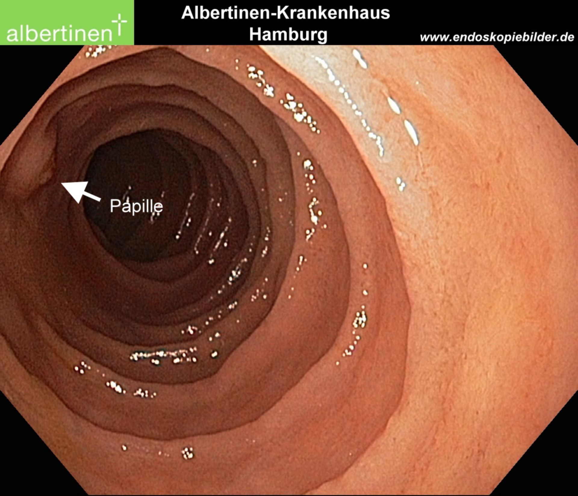 Duodenum-desc-Papille Endo Pfeile