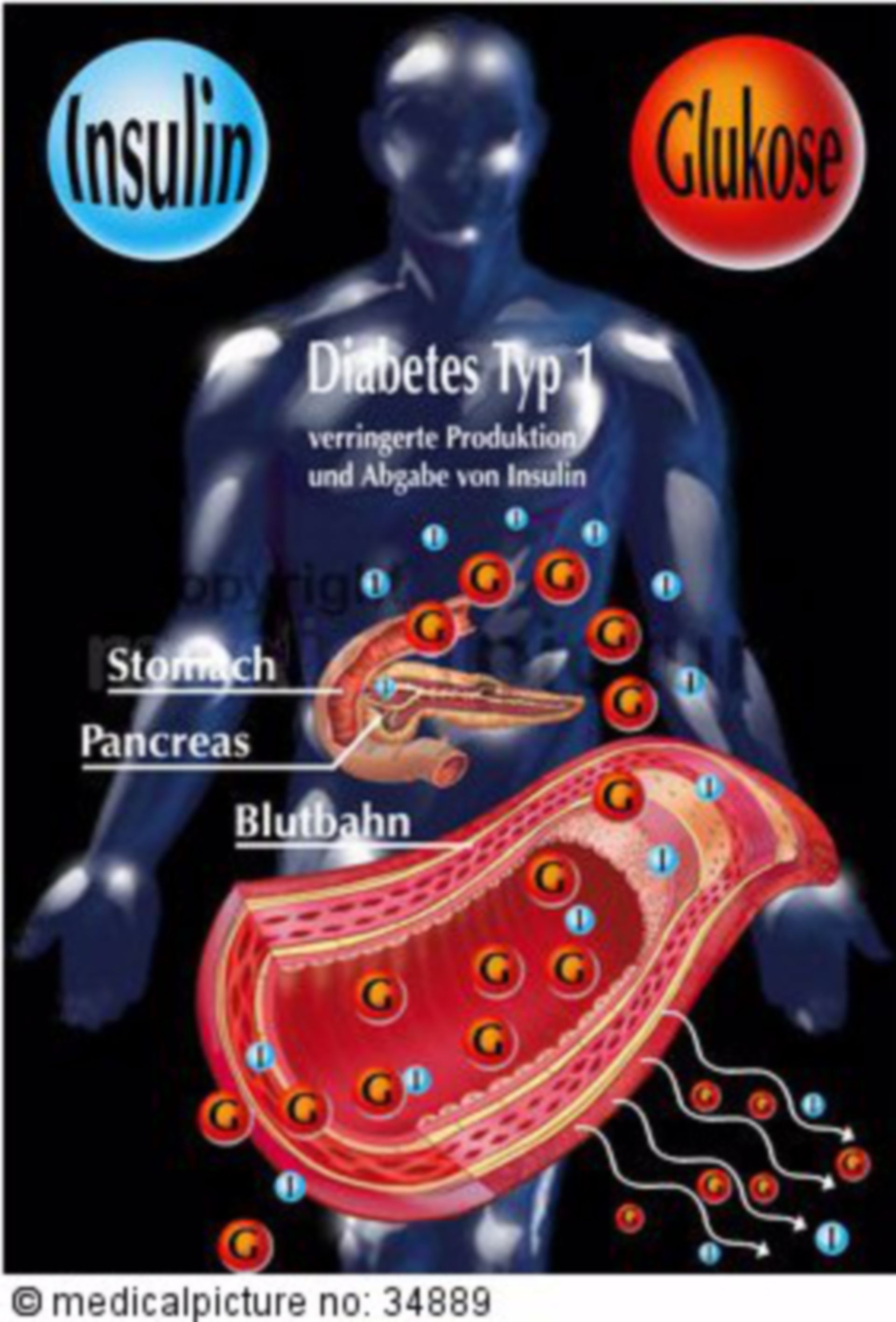 Insulin secretion of people with type I diabetes
