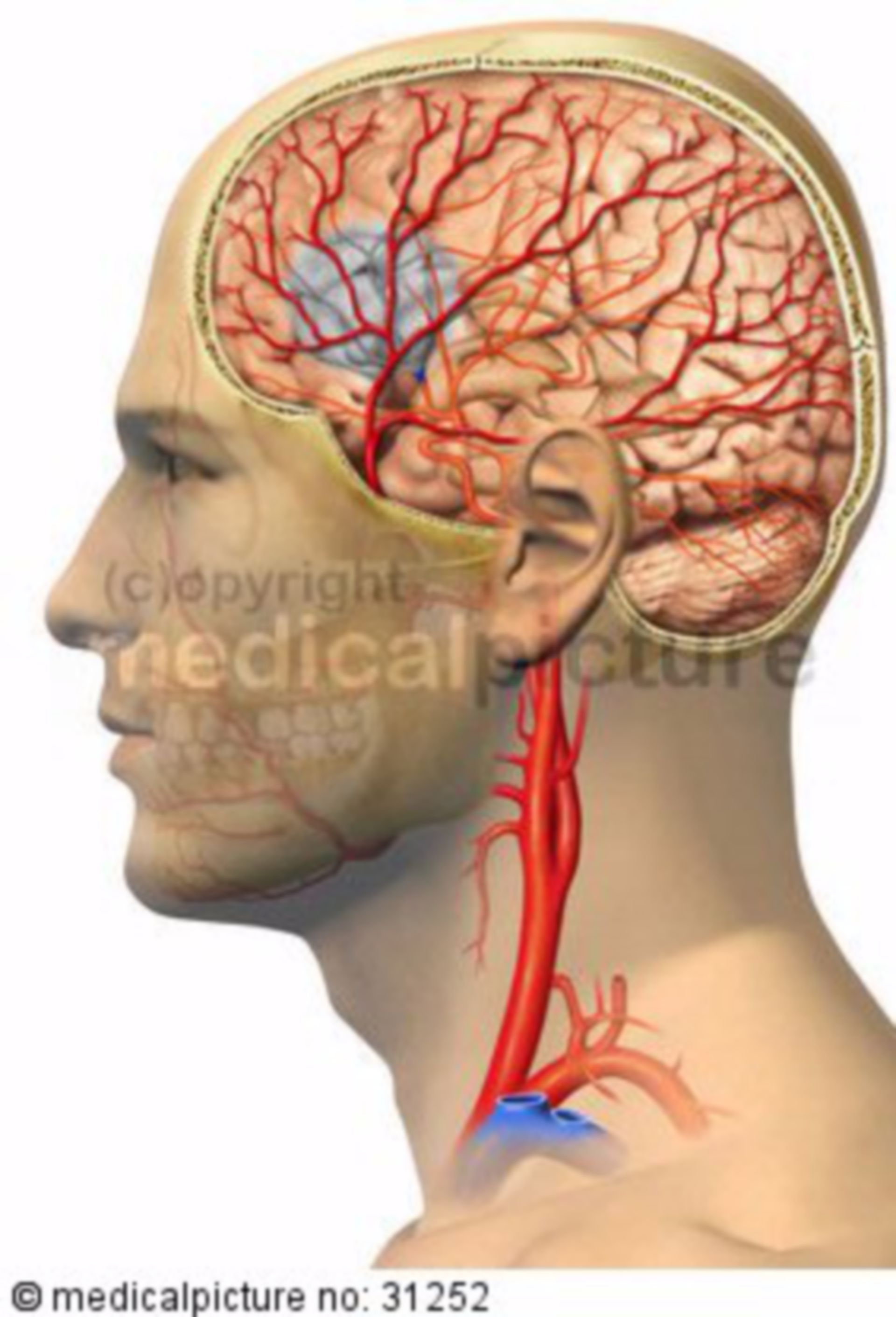 Stroke cause by a Thrombus