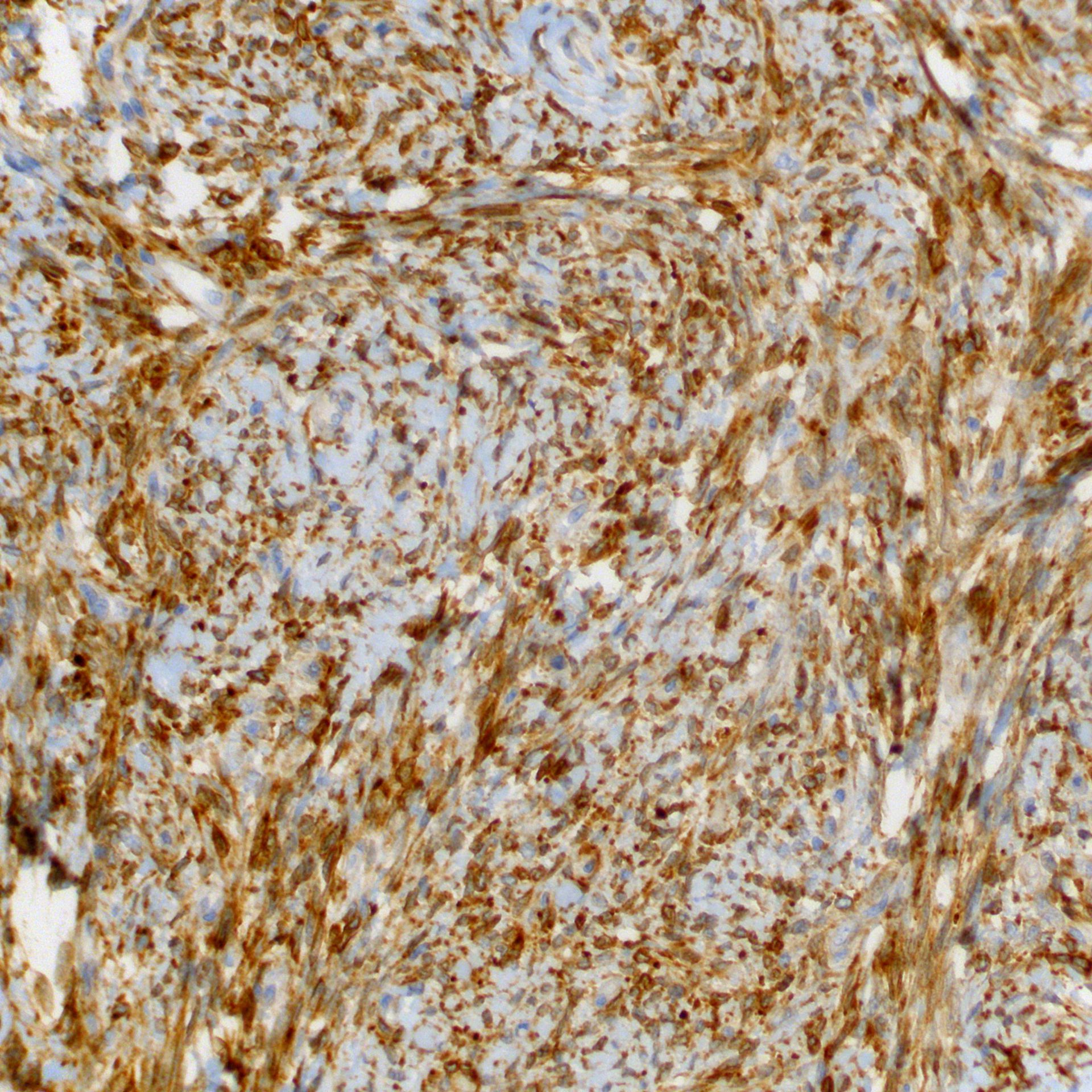 Solitary fibrous tumor (SFT)