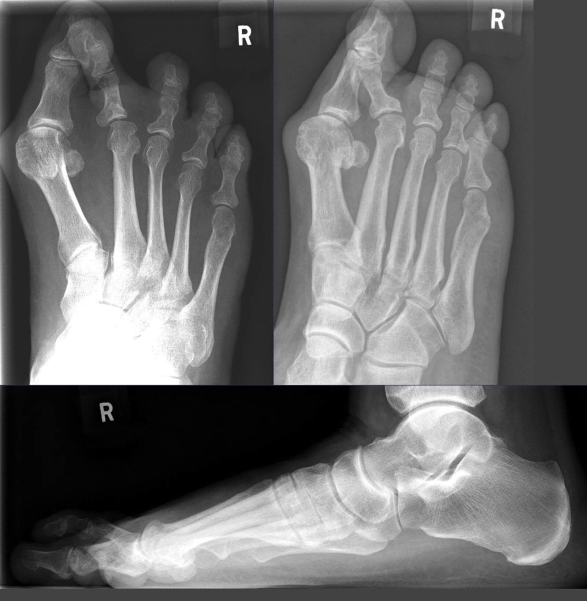 Hallux valgus und Digitus superductus