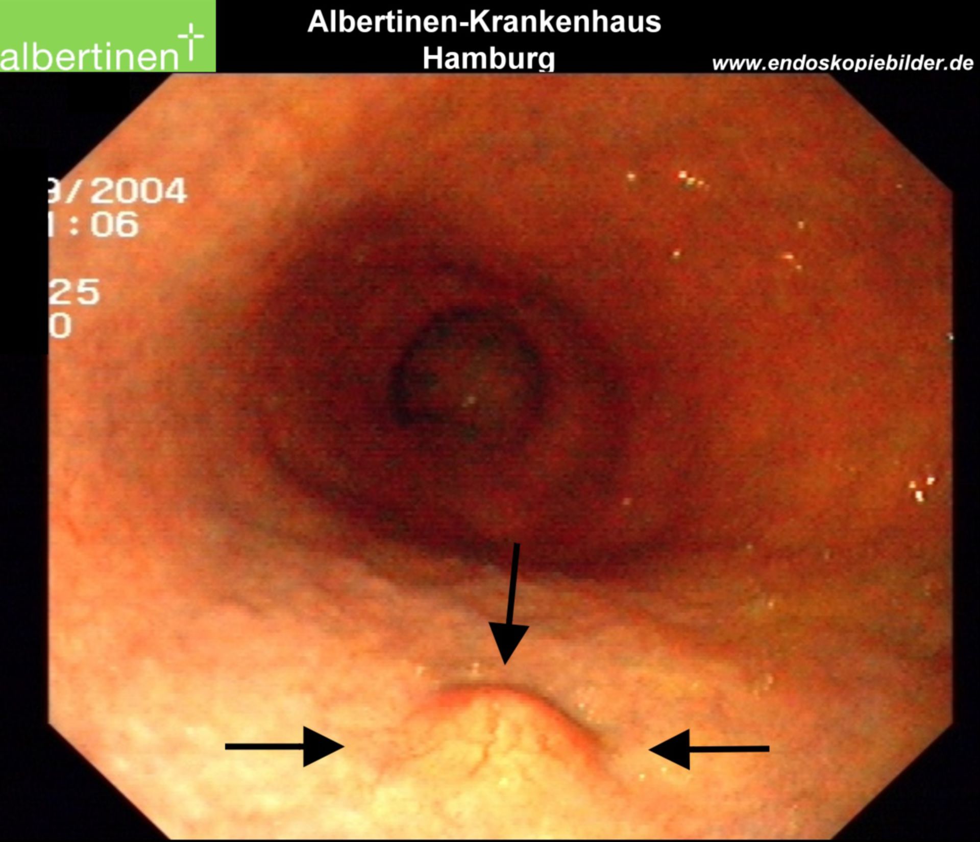 Endoscopia: carcinoide