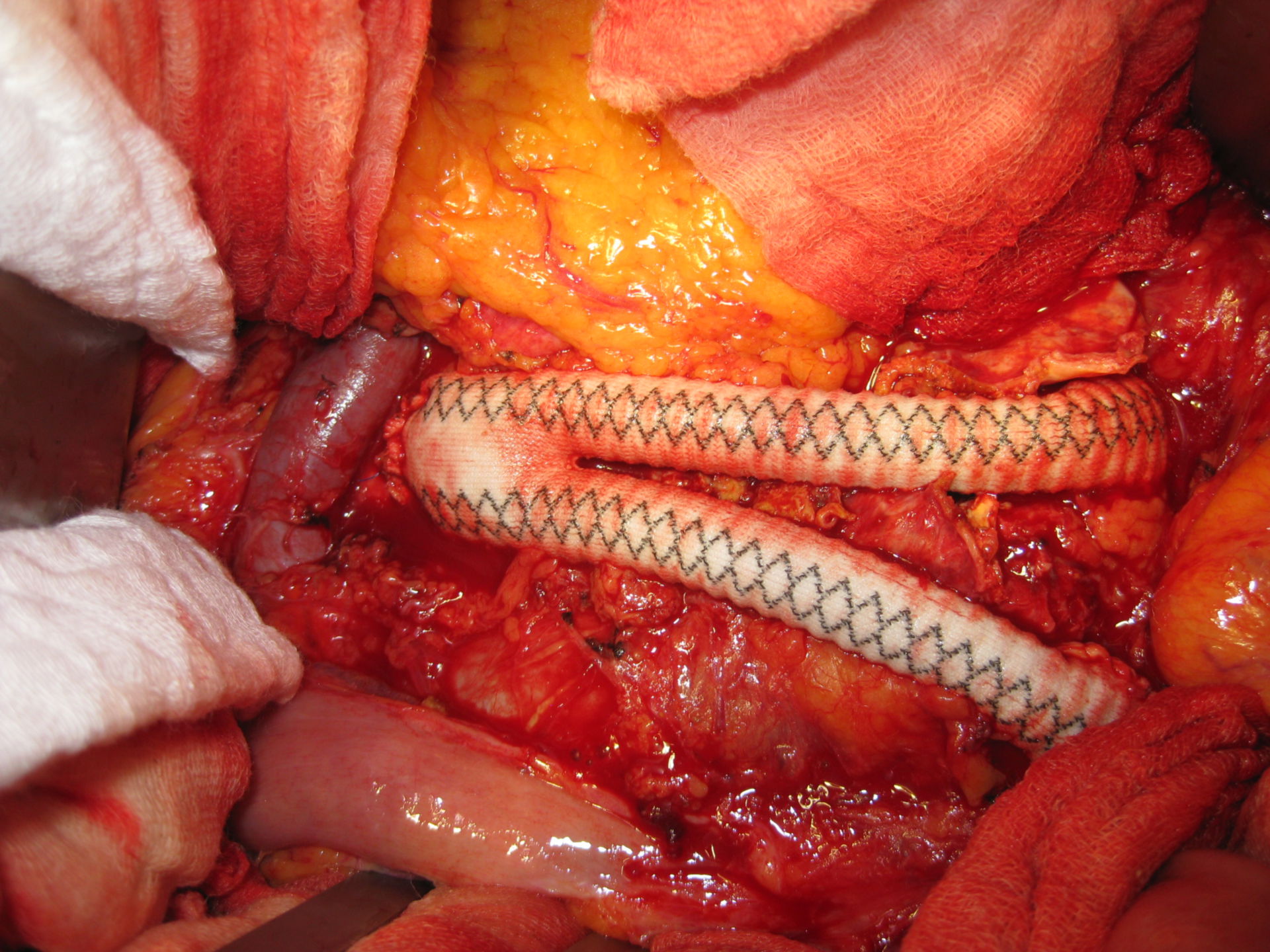 Bauchaortenaneurysma - Y-Prothese nach Resektion/Ausschaltung