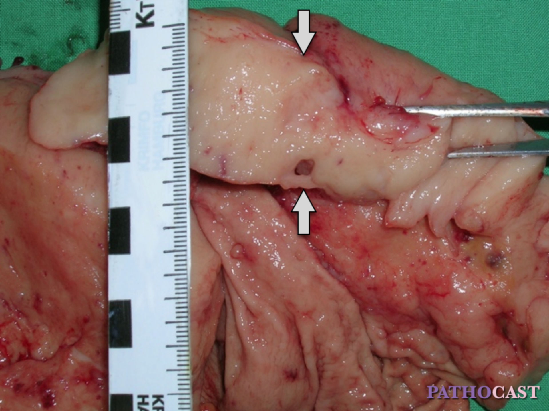 MALT lymphoma of stomach