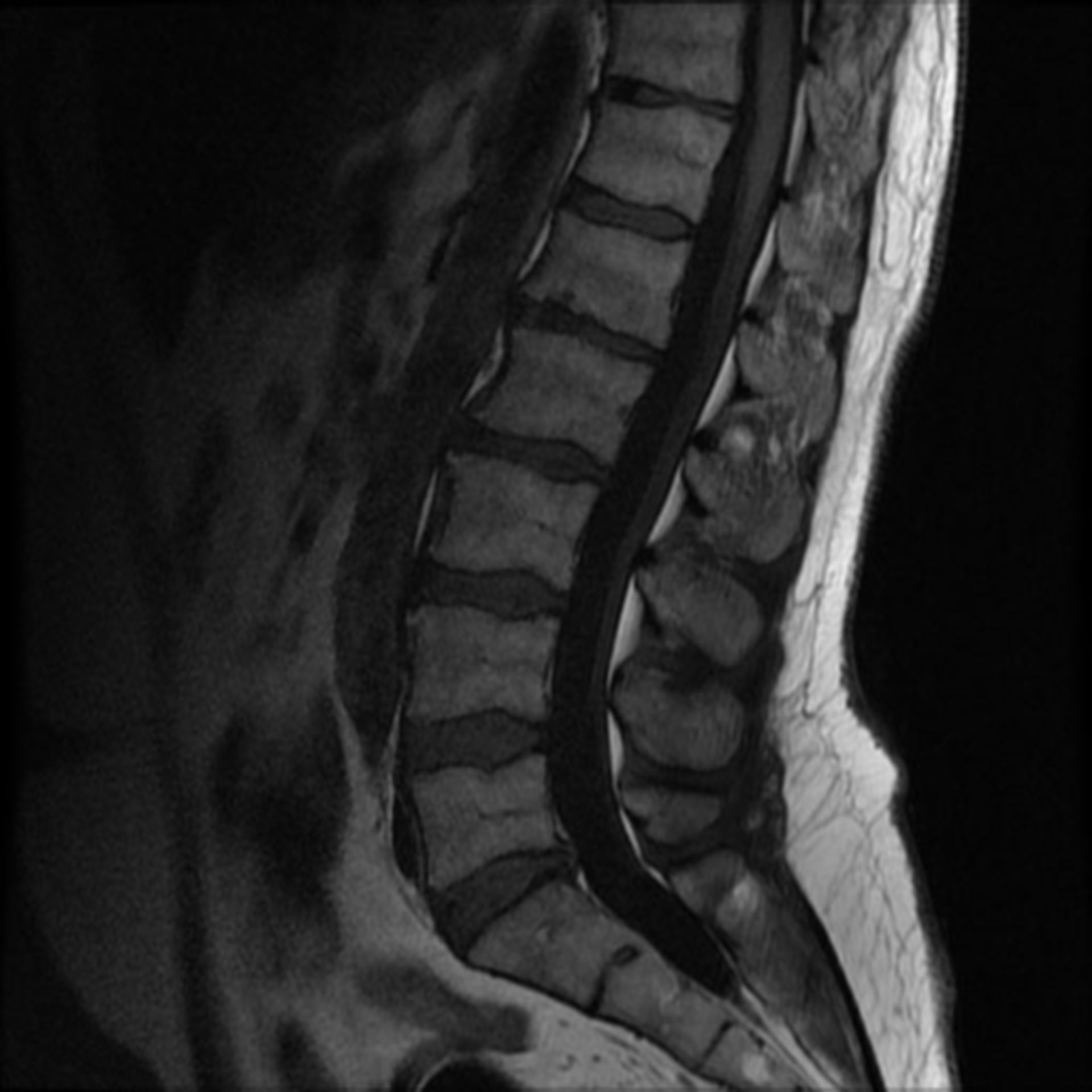 CT scan of lumbar spine