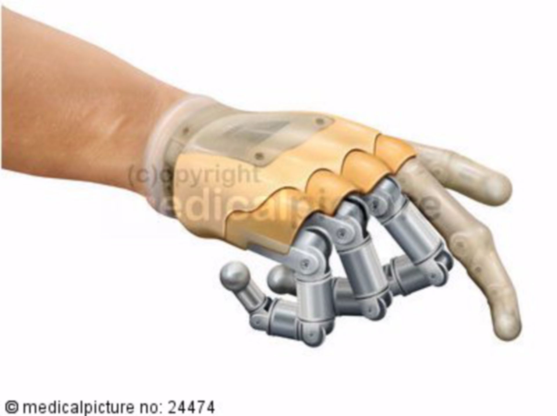  Modellierung einer Handprothese 
