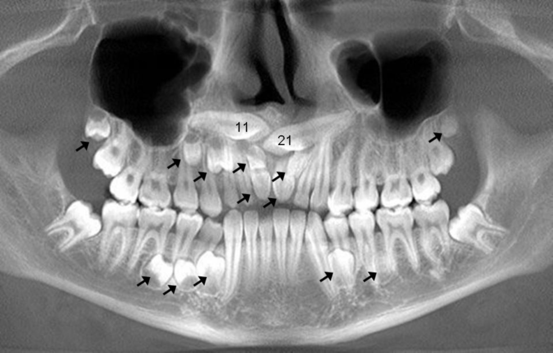 Multiple, supernumerous teeth