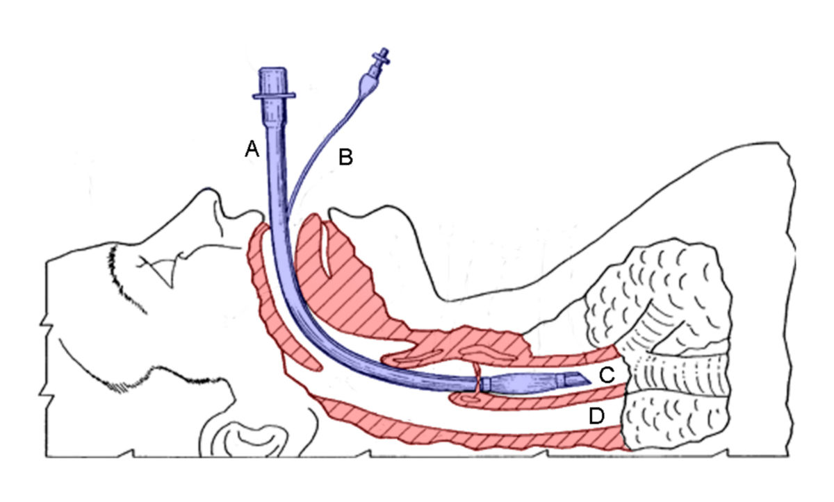 Endotracheale Intubation (Schema)