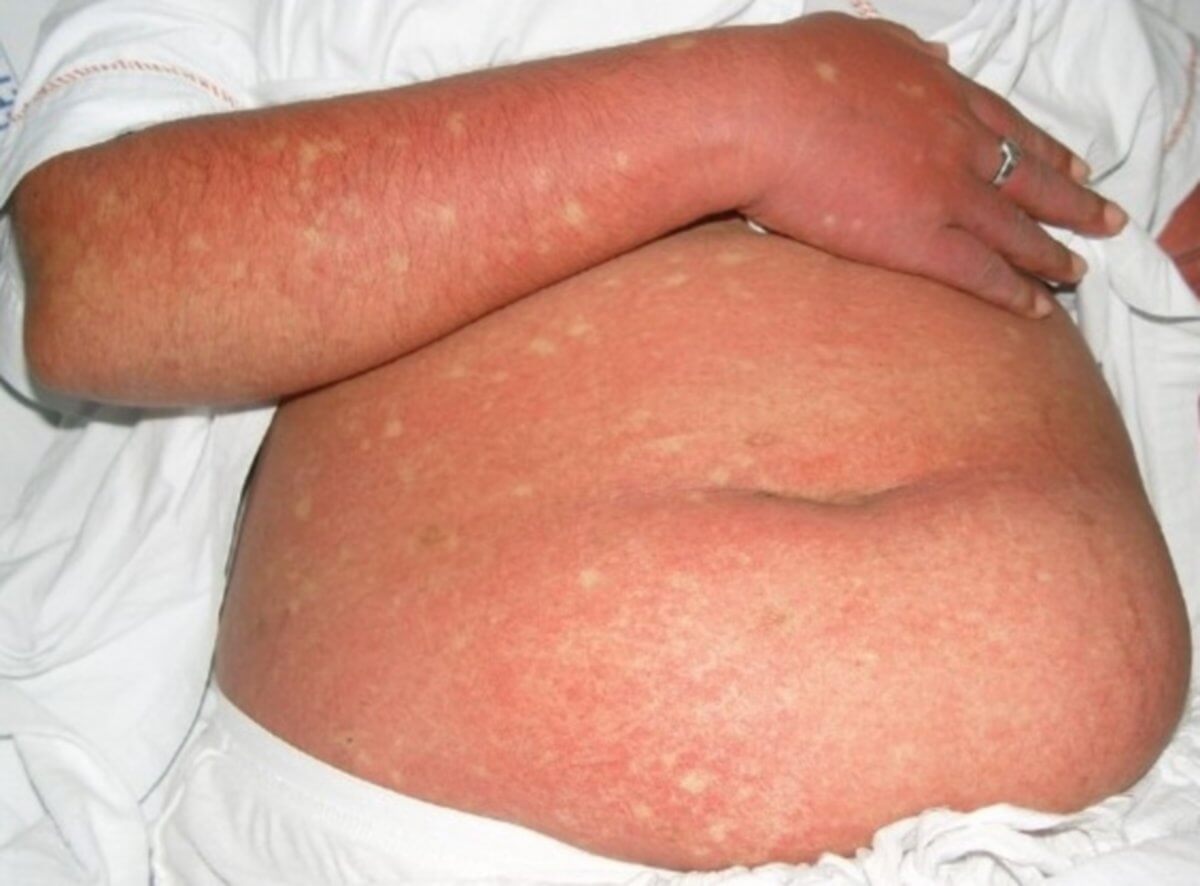 Morbilliformes Exanthem bei Dengue-Fieber