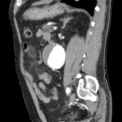 Thorakales Aortenaneurysma Doccheck Flexikon