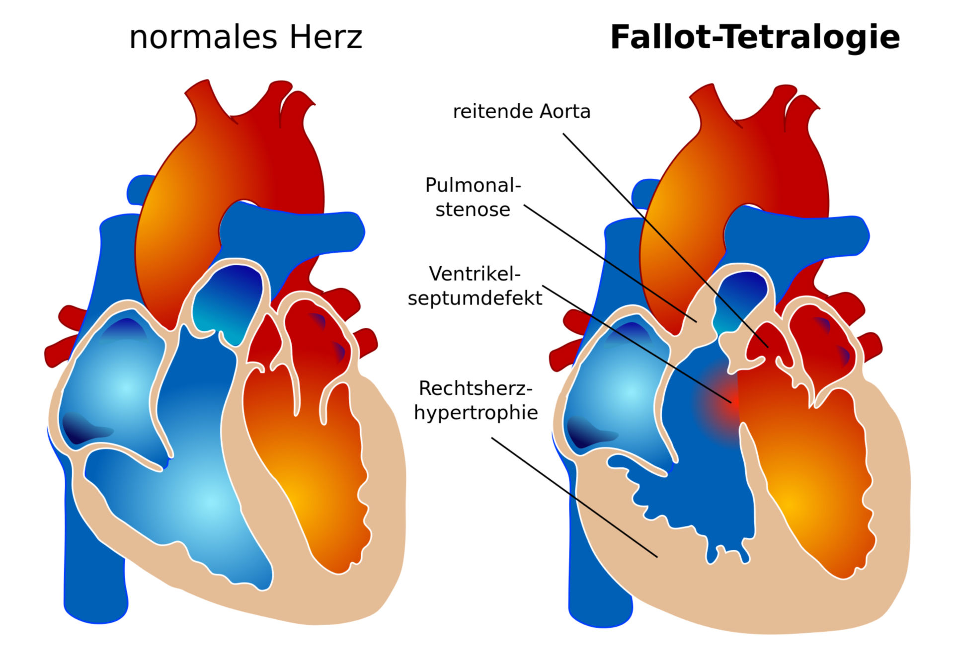 Morphology of Tetralogy of Fallot