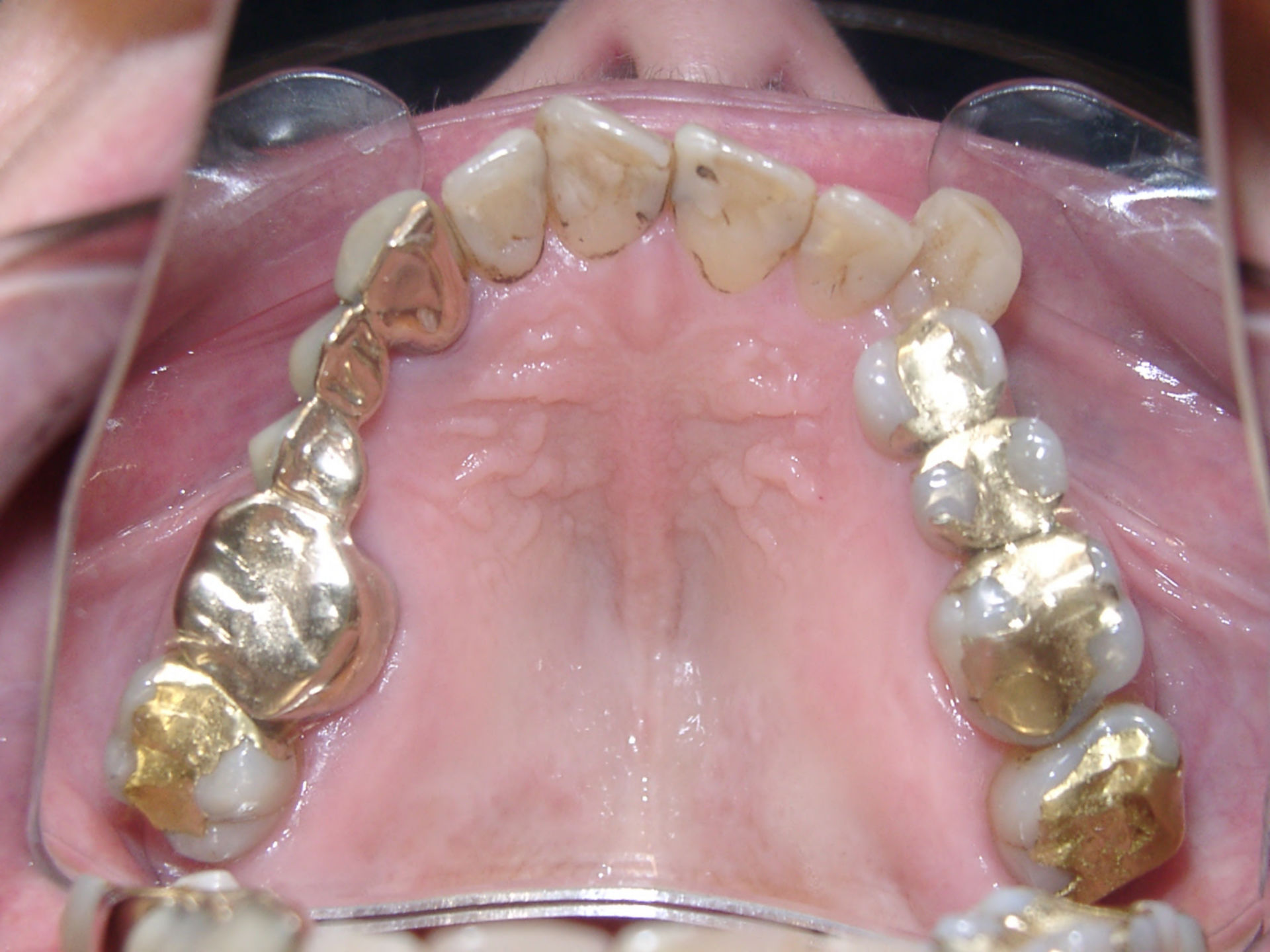 71-year-old female patient (maxilla) before orthodontics