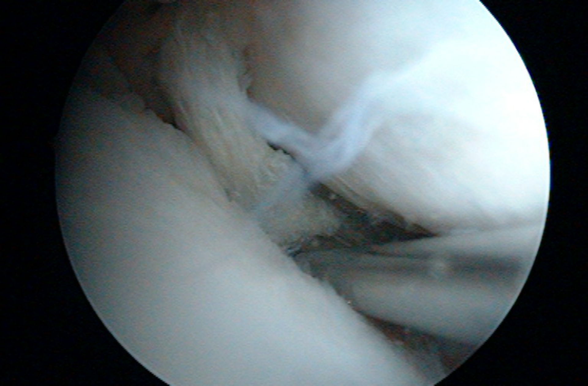 Rupture of the Medial Meniscus