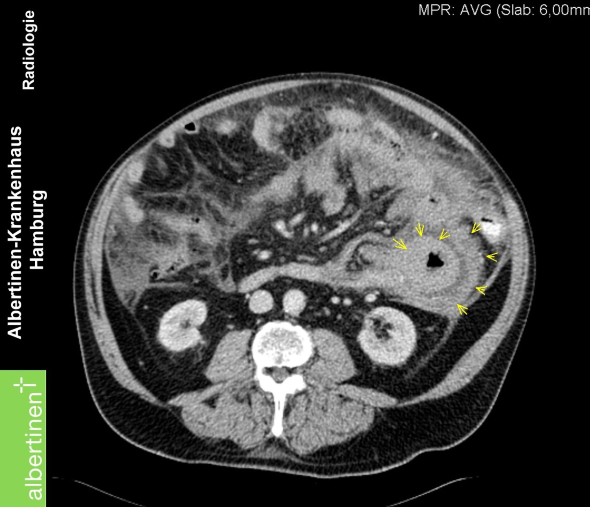 Burkitt-Lymphom Dünndarm CT