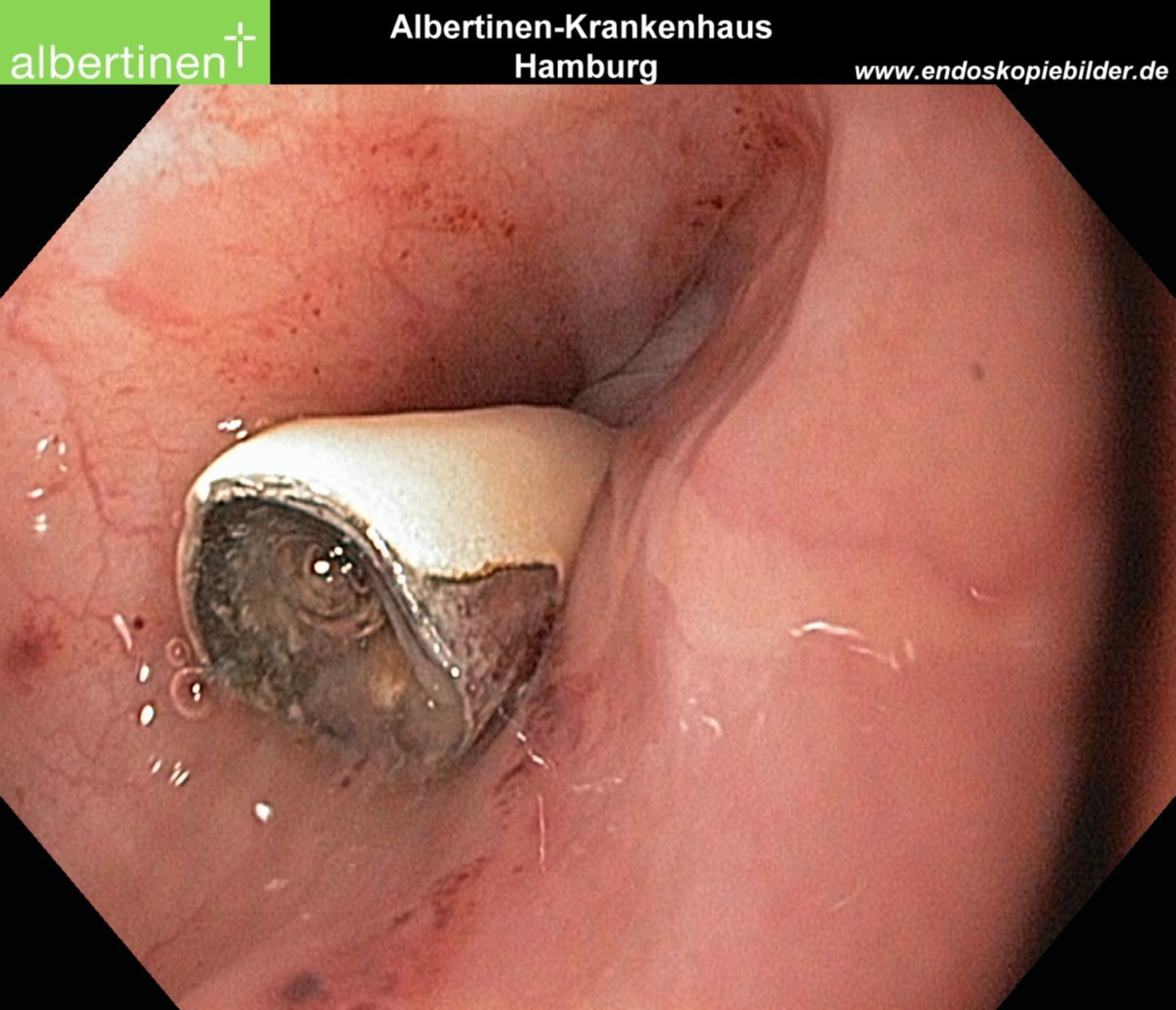 Tooth in esophagus after intubation