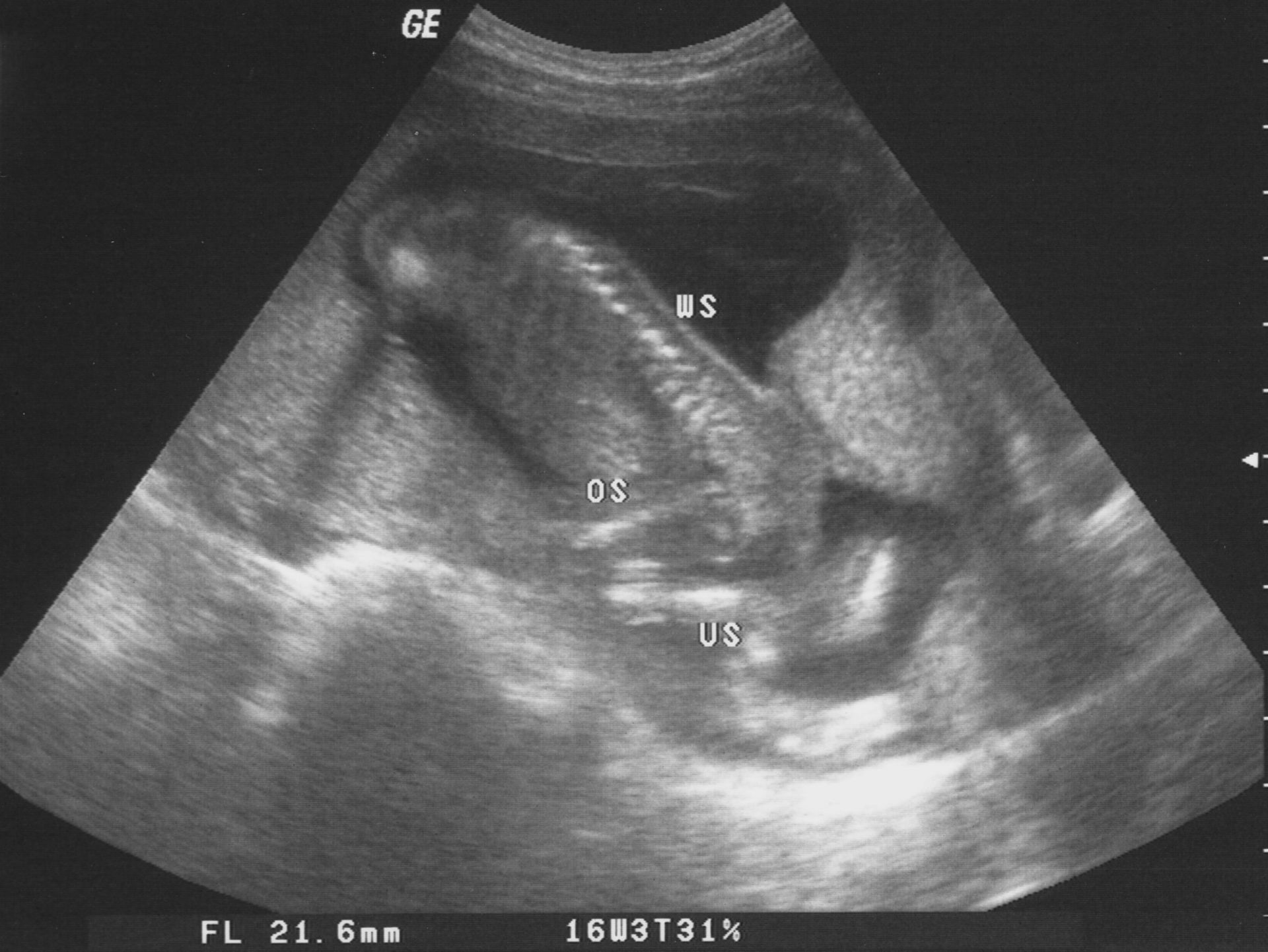 Ultrasonido de 18 semanas de gestación