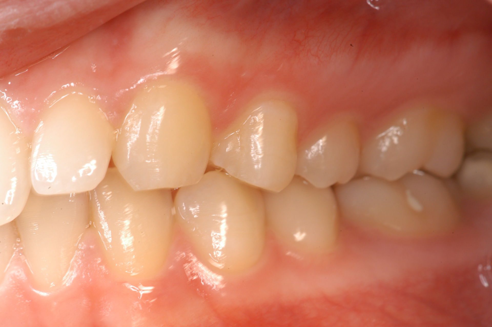 Denti sani per cavità senza diritto