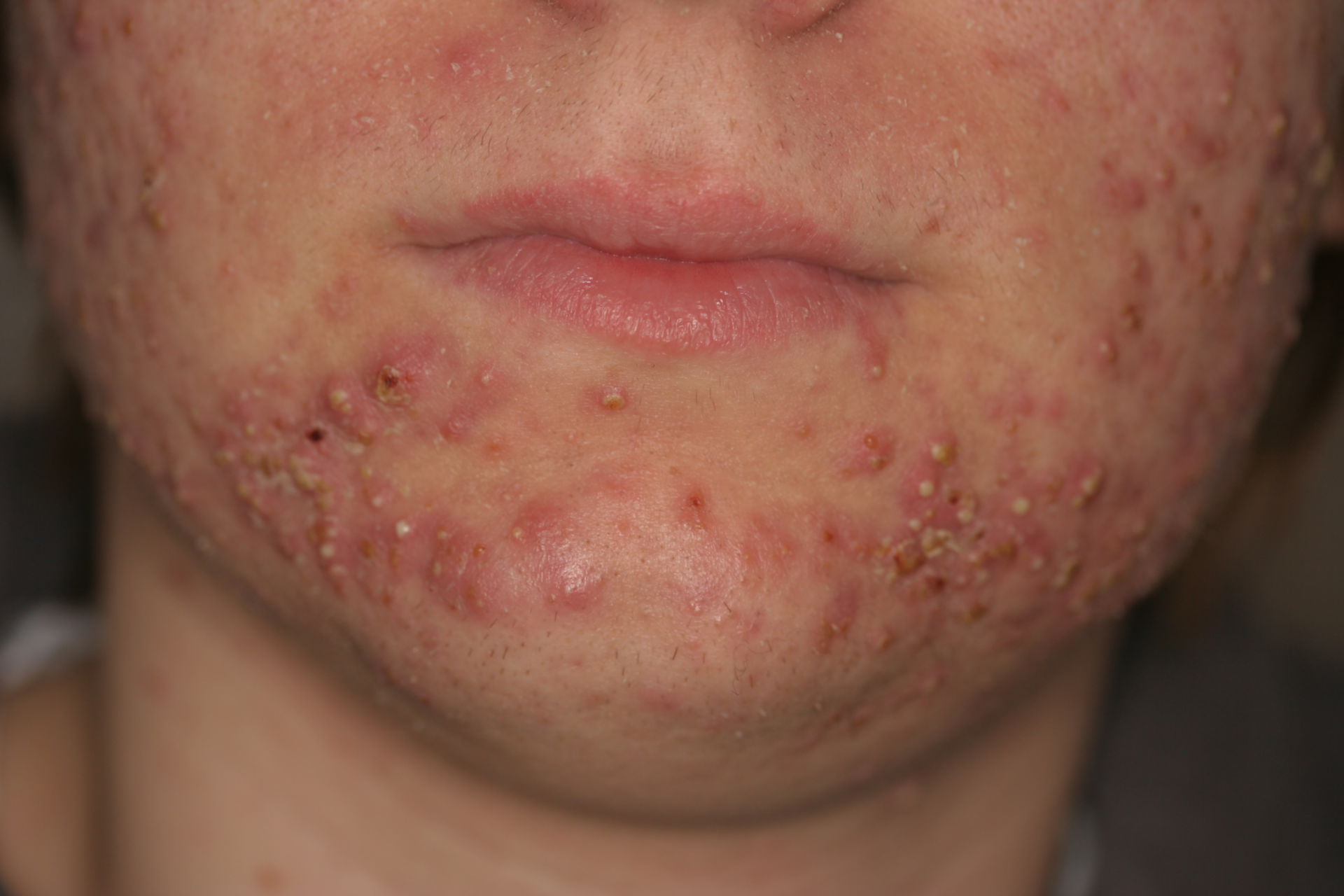 Papular and pustular acne