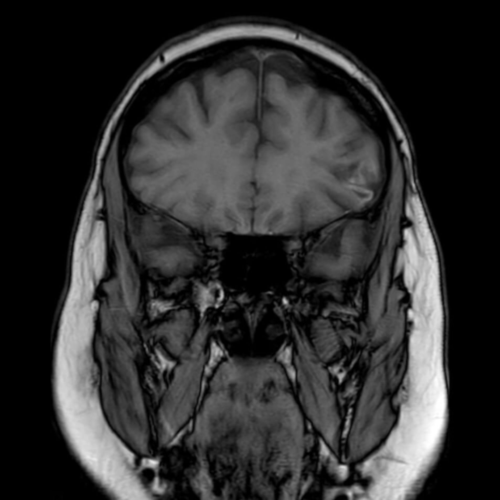 Kontrollaufnahme bei hämorrhagischem Infarkt