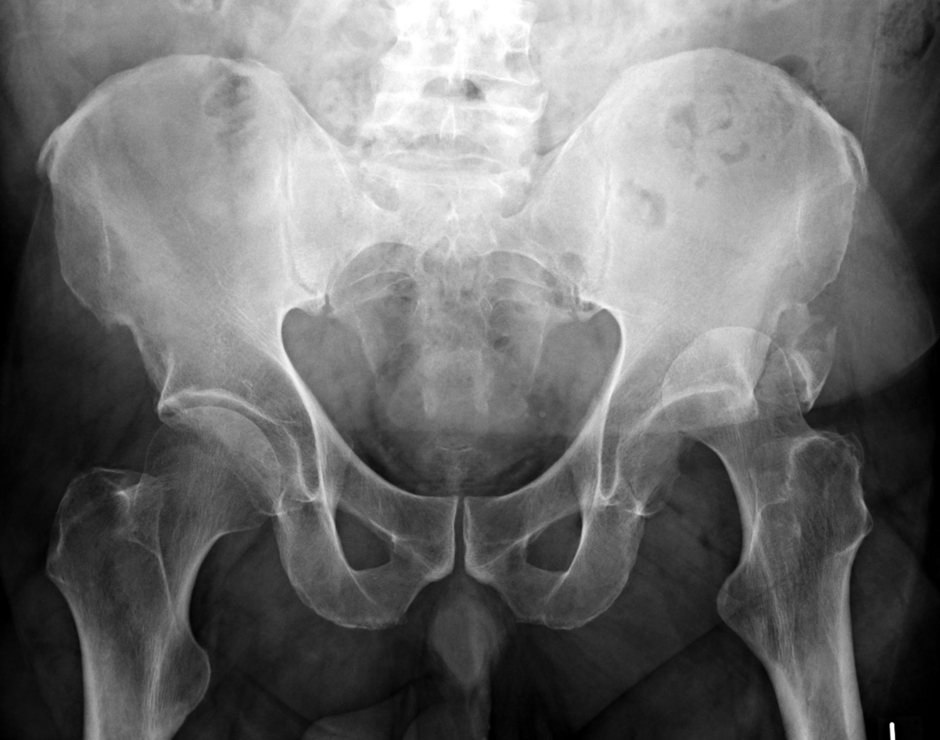 Left-sided hip dislocation with avulsion fracture of the pelvic bone 1