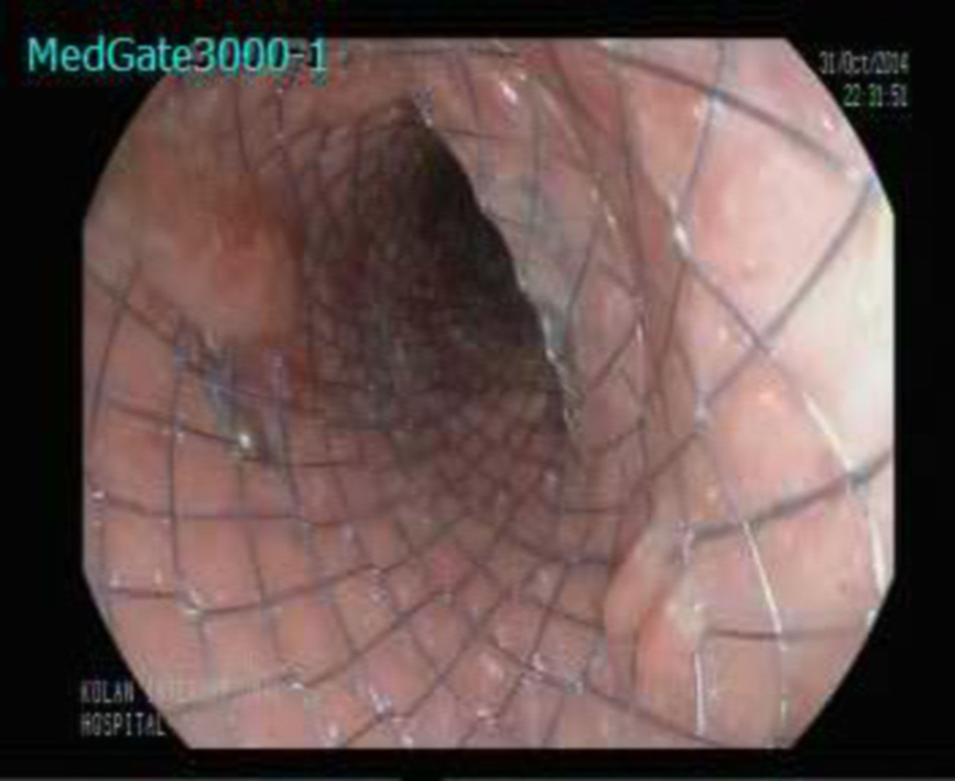 Endoscopic view of a self-expandable coated stend for the treatment of a sleeve gastrectomy leak
