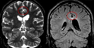 Magnetresonanz-Aufnahmen eines Patienten mit fokaler kortikaler Dysplasie vor (links) und nach der Operation. Blick von hinten auf das Gehirn. © Universitätsklinikum Freiburg