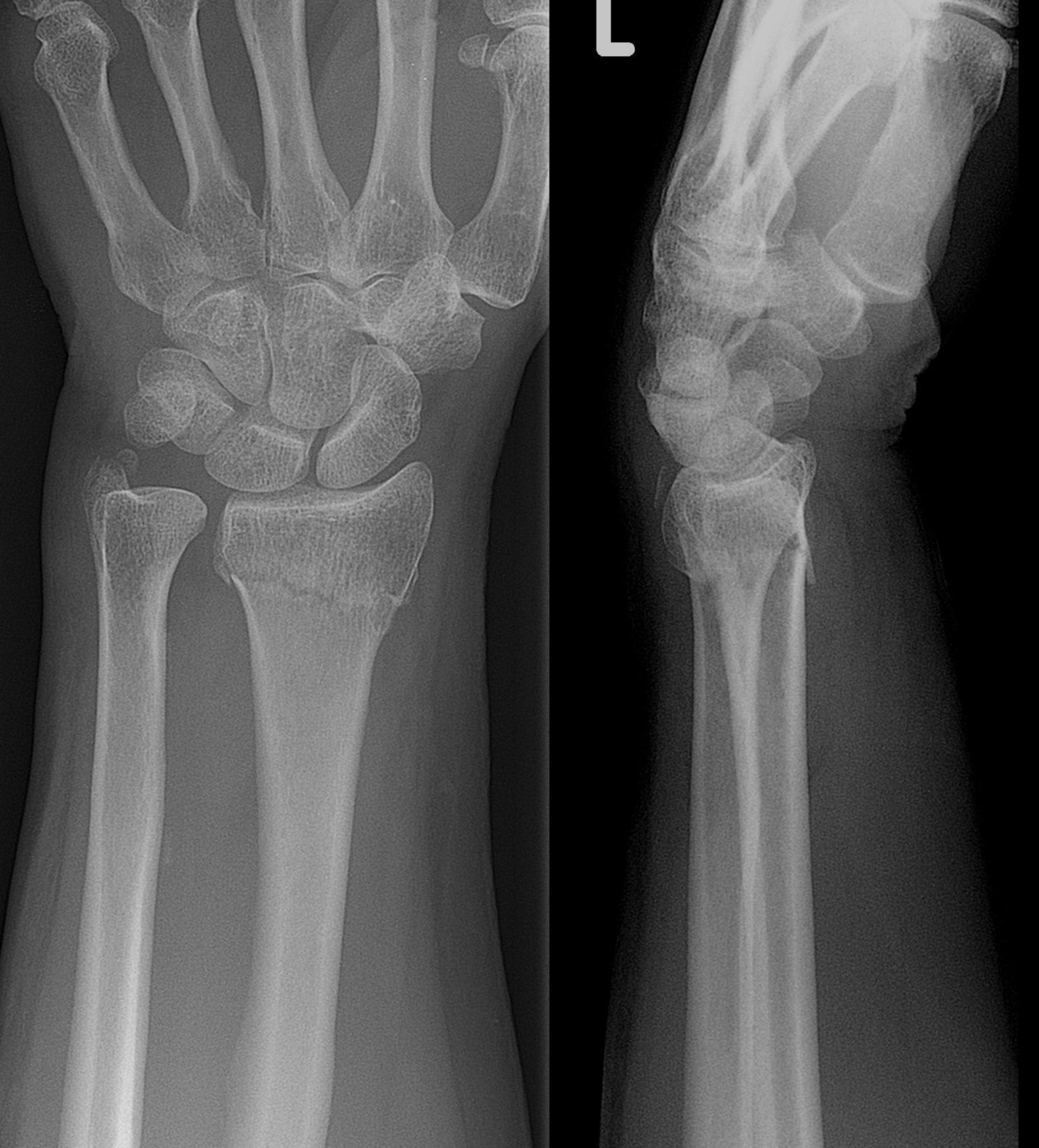 X-ray of a collesfracture of the left wrist