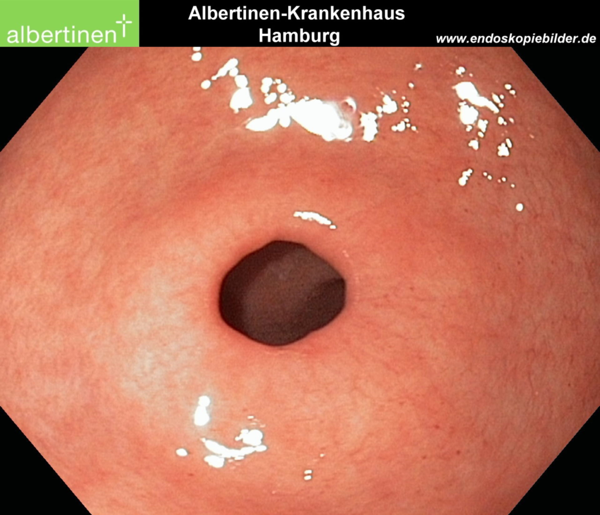 Endoscopy: Pylorus of the stomach, normal finding