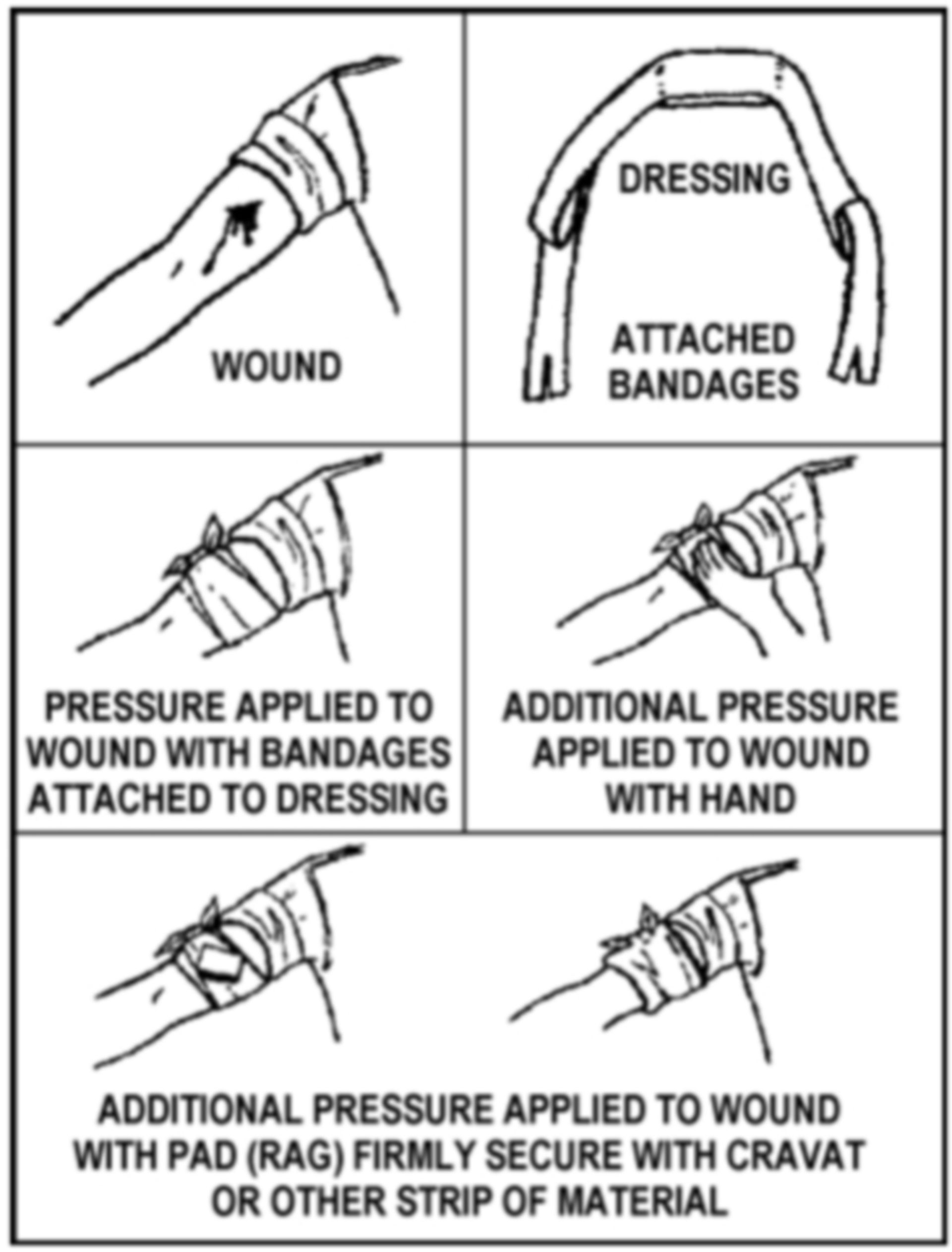 Placement of a pressure dressing