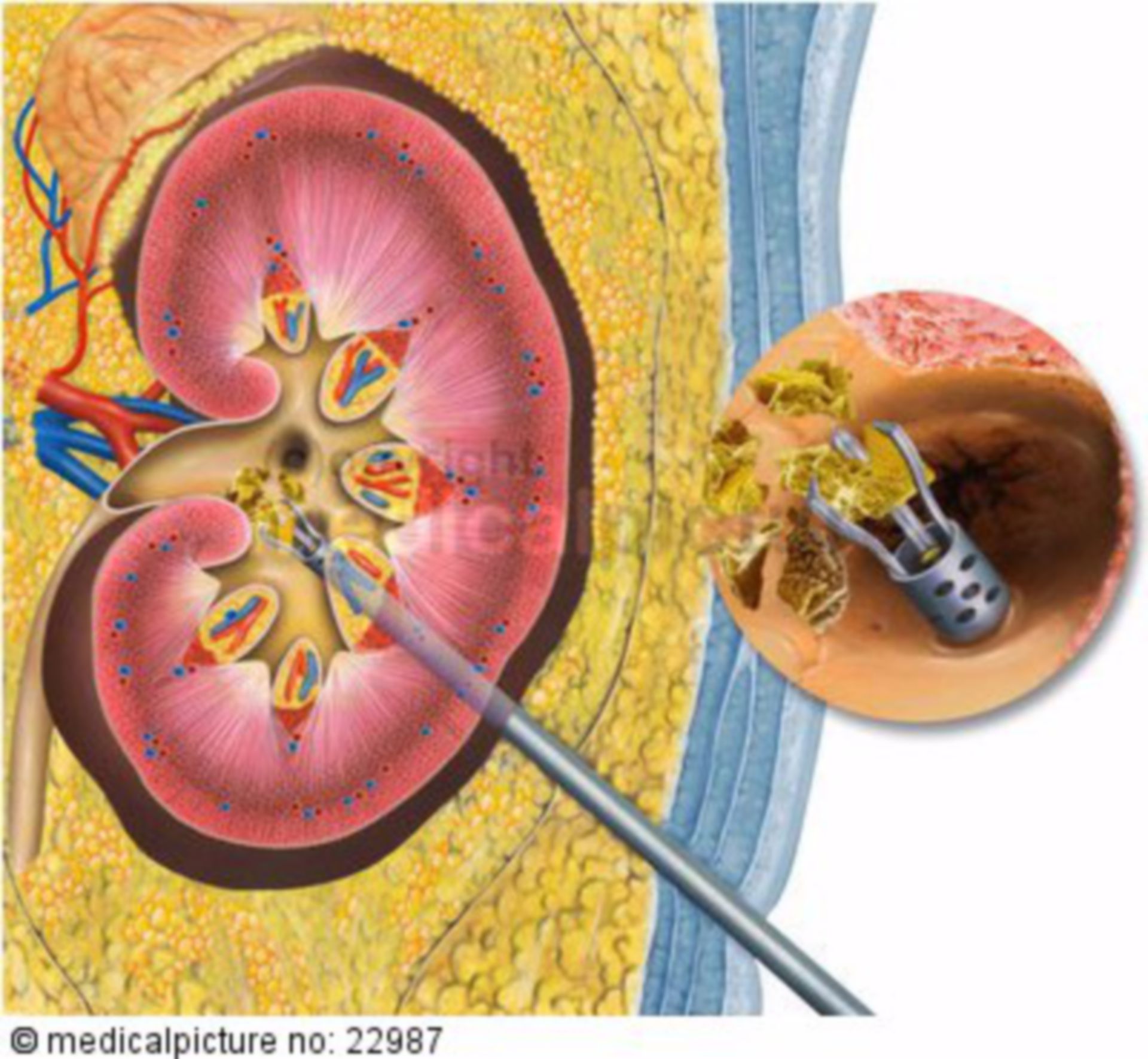 Kidney Stone Biopsy with Kidney Stone Disease, Kidney - DocCheck