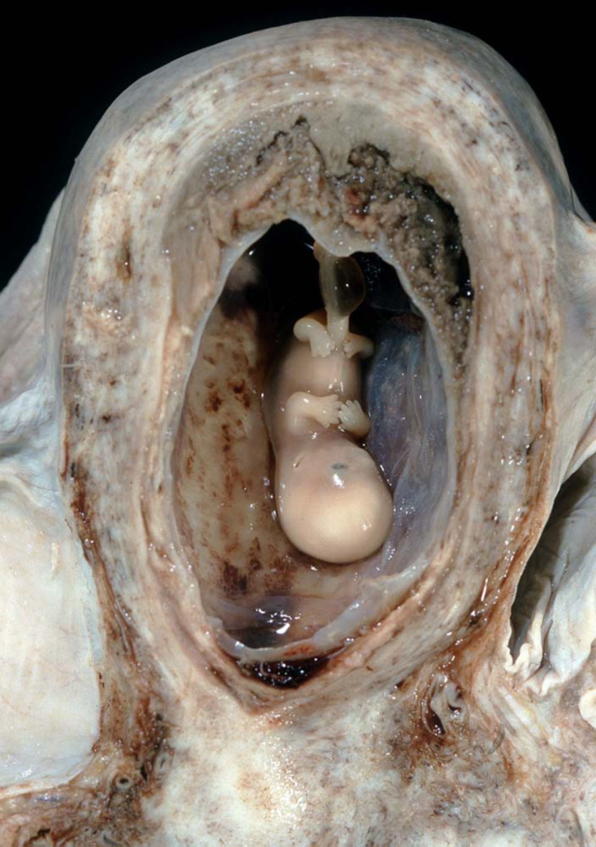 Intrauterine fetal death, 10 weeks of gestation